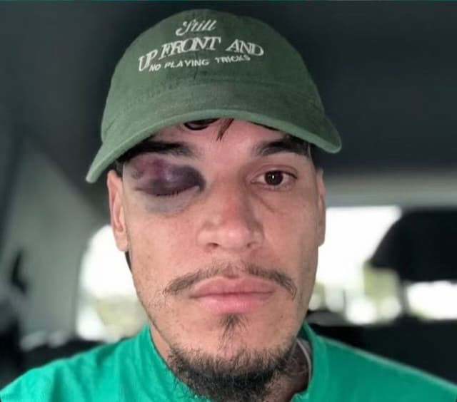 Gómez publica foto de olho roxo após pancada em jogo do Palmeiras