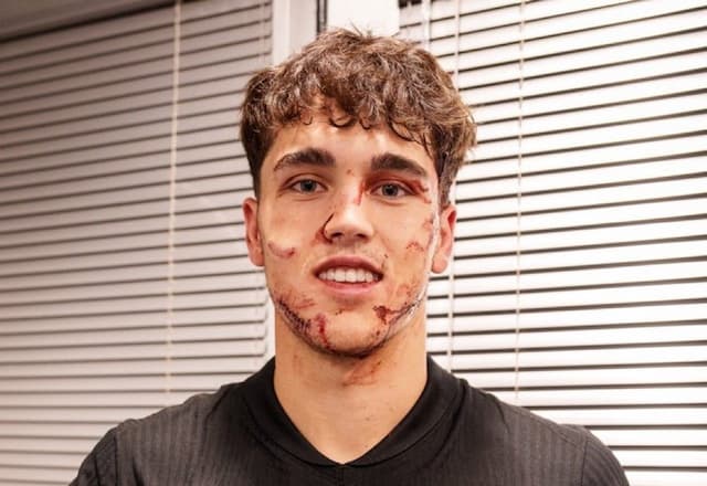 Zagueiro do Barcelona leva 10 pontos no rosto após choque em jogo da Champions